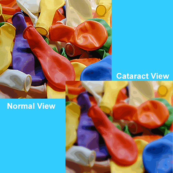 Normal vision vs Cataract vision